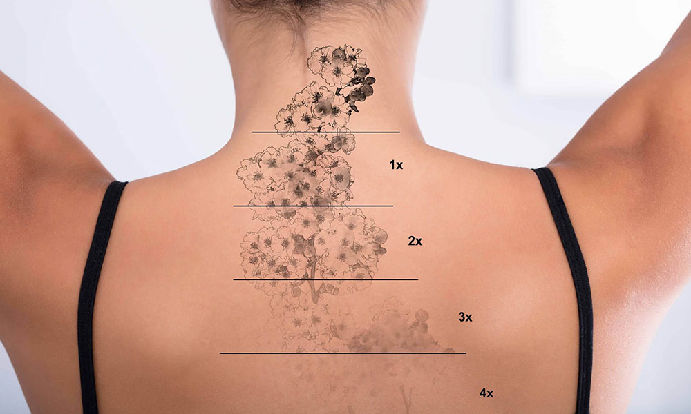 Lazerle Dövme Silme