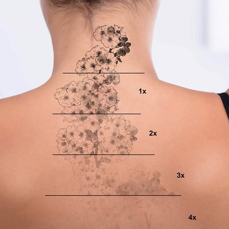 Lazerle Dövme Silme